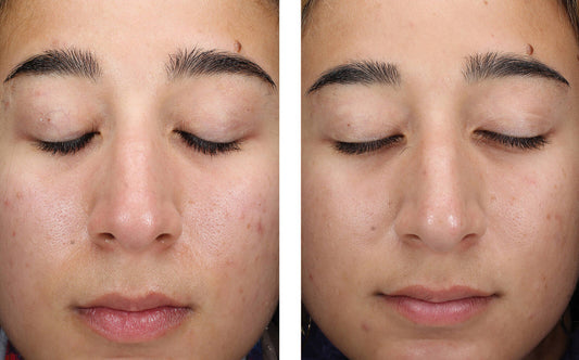 AlphaRet Clearing Serum before and after