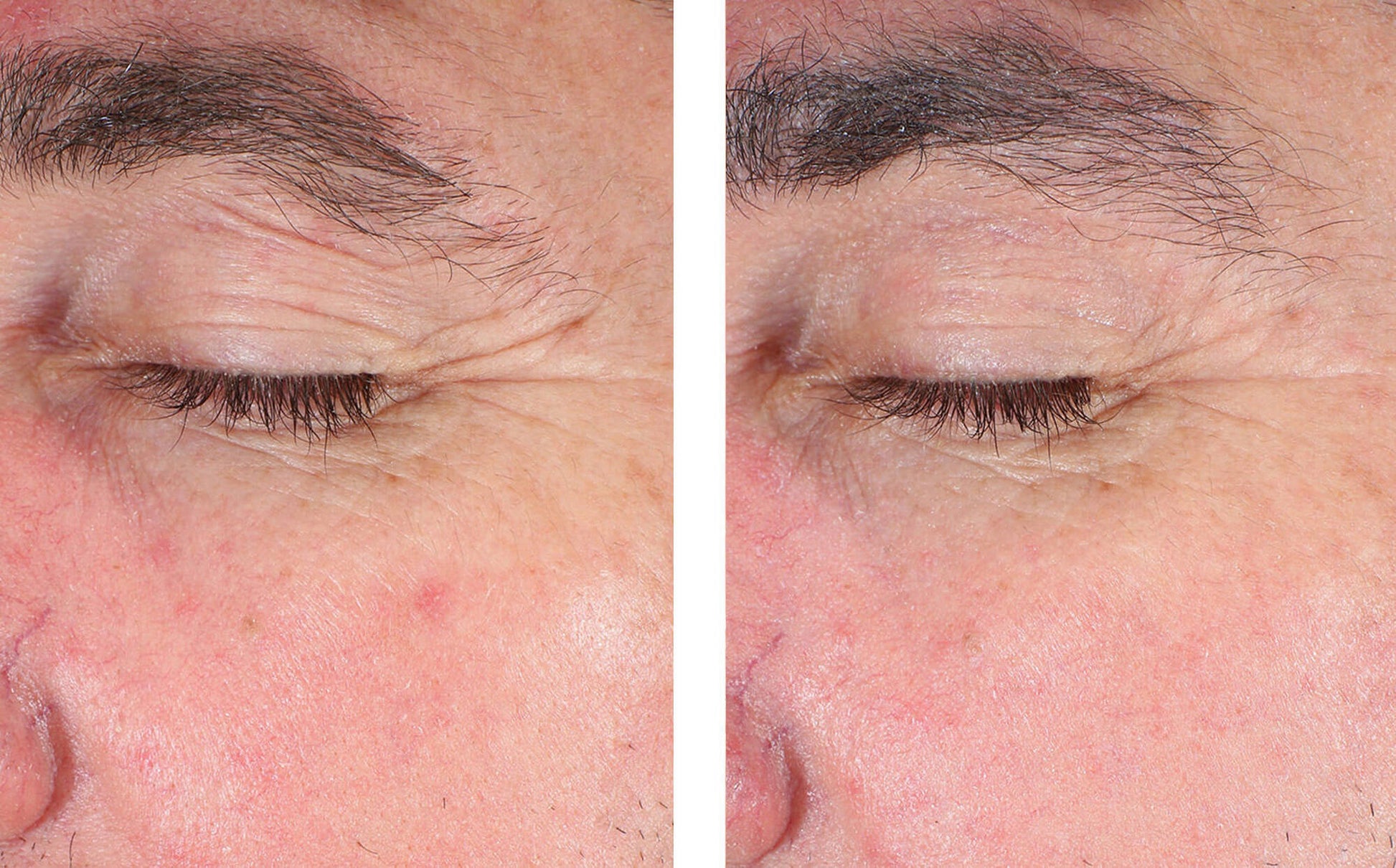 skinbetter eyemax eye cream before and after