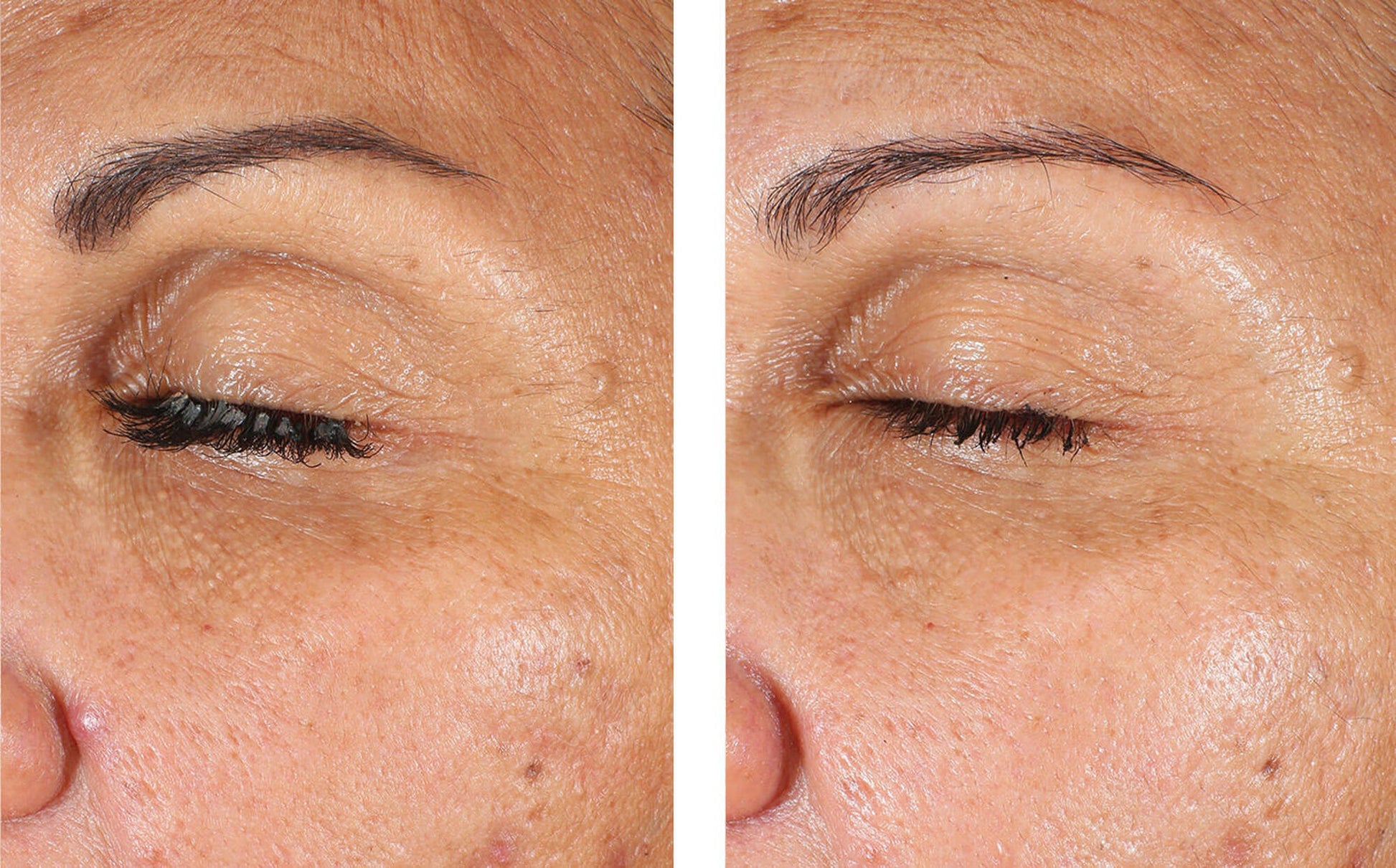 skinbetter eyemax eye cream milia before and after
