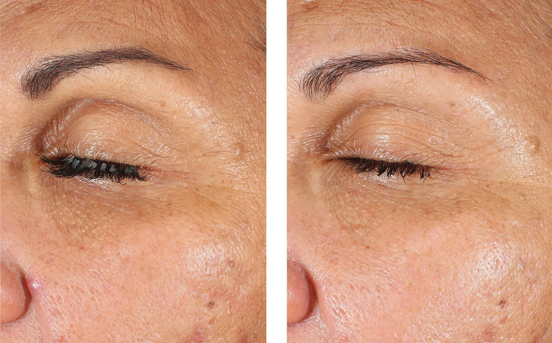skinbetter eyemax eye cream milia before and after
