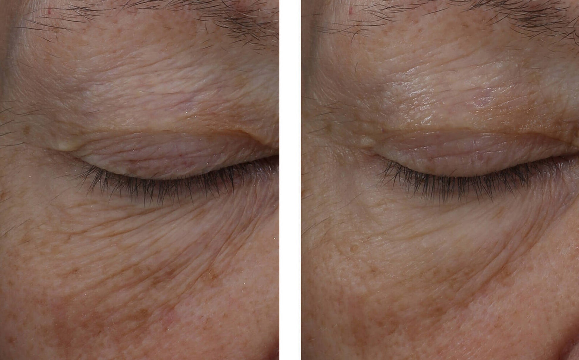 skinbetter interfuse eye cream before and after