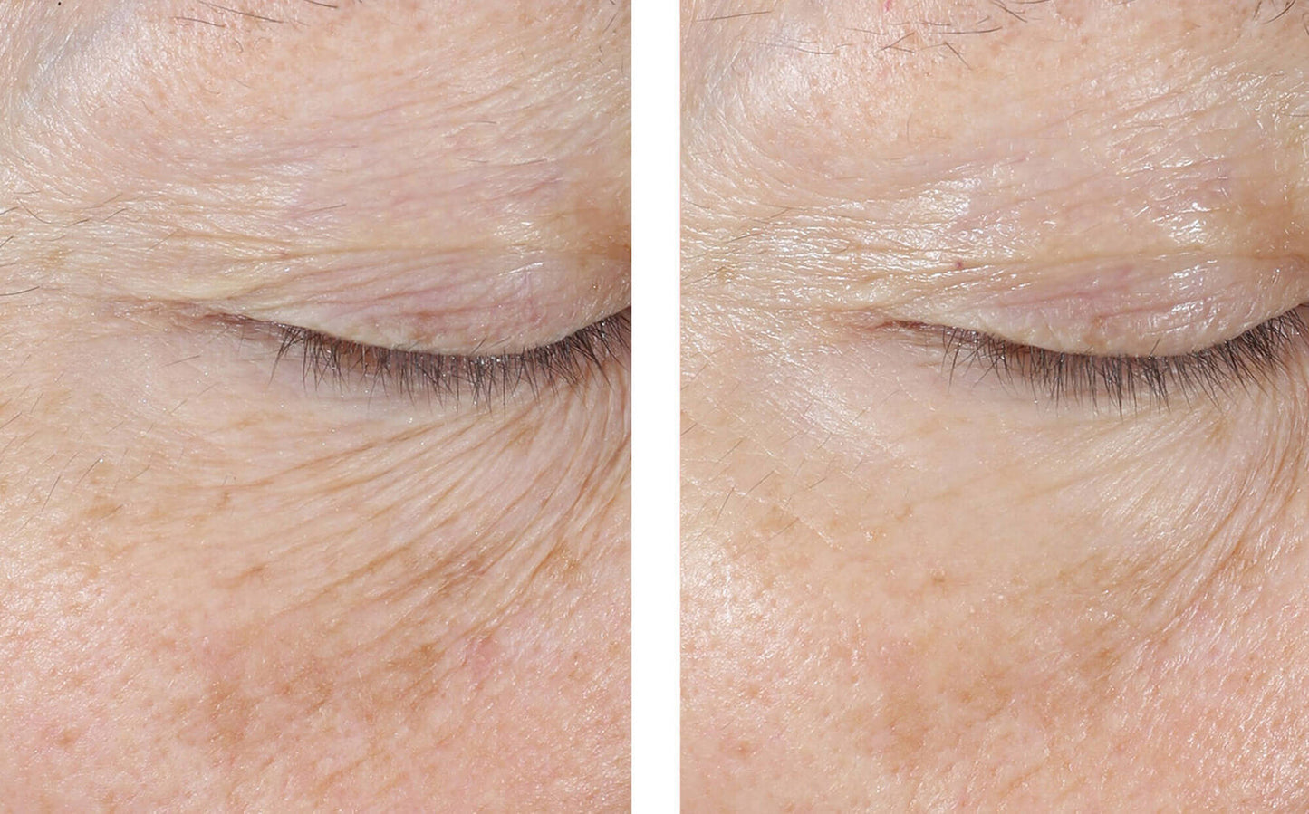 skinbetter interfuse eye cream before and after 4 weeks
