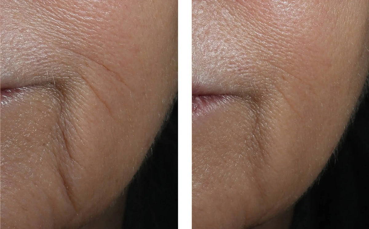 Interfuse skinbetter lines before and after