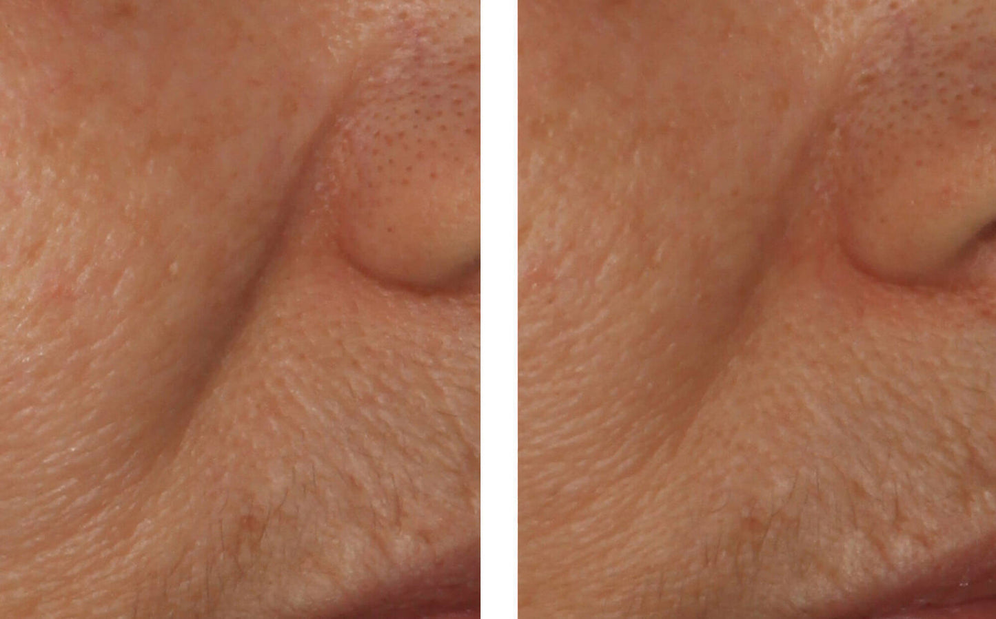 skinbetter lines before and after