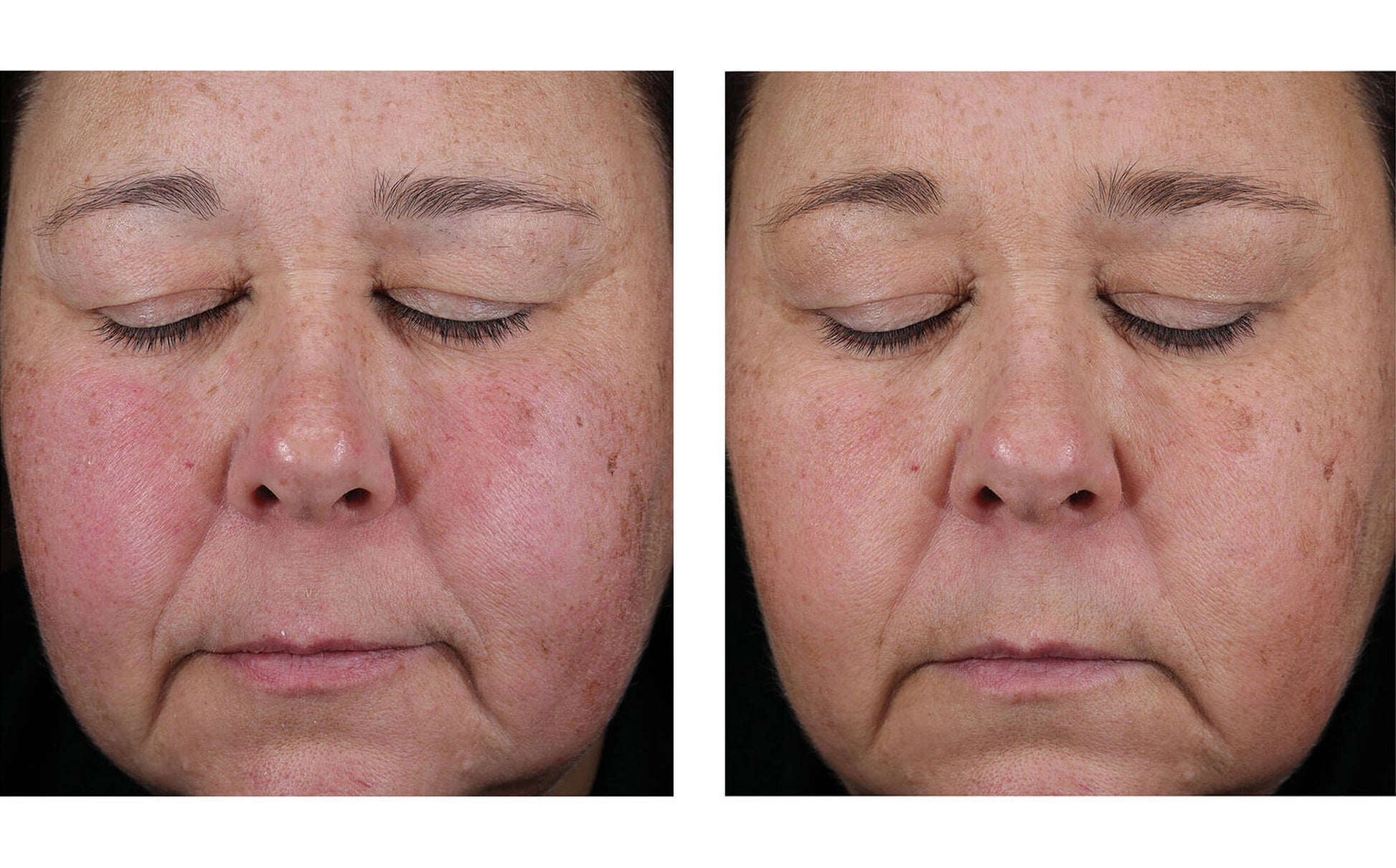 skinbetter Mystro Active Balance Serum  before and after 2 weeks