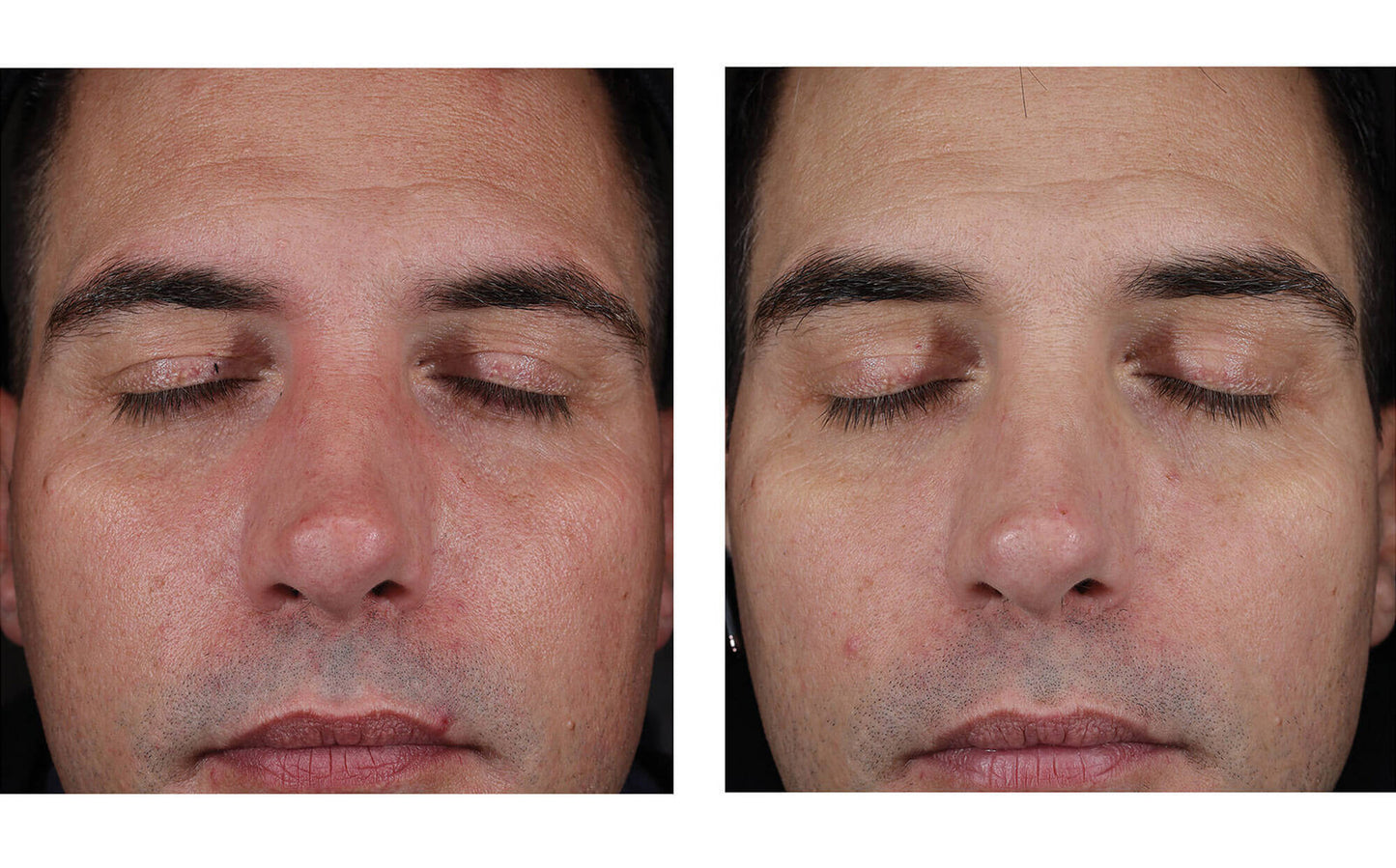 skinbetter Mystro Active Balance Serum  before and after 8 weeks