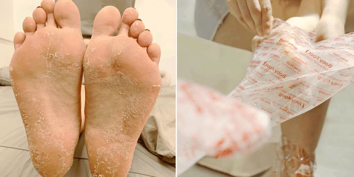 Original Exfoliation Foot Peel