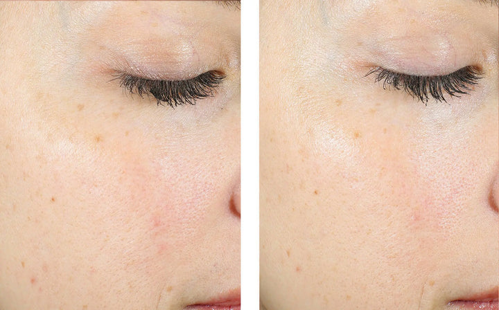 Skinbetter | AlphaRet Exfoliating Pads before and after