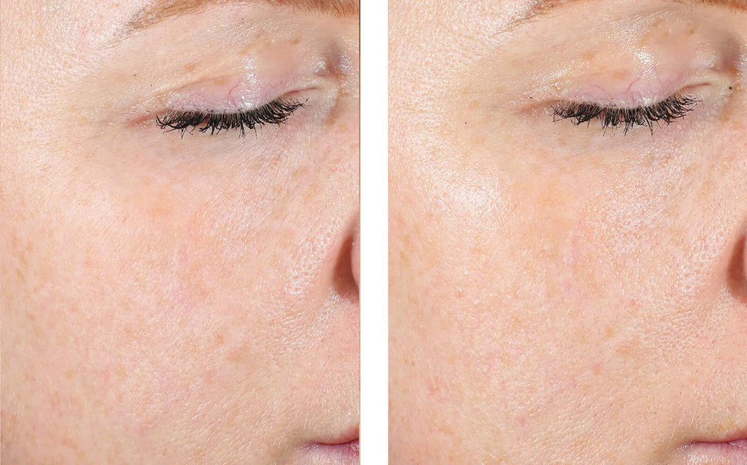 Skinbetter | AlphaRet Exfoliating Pads before and after