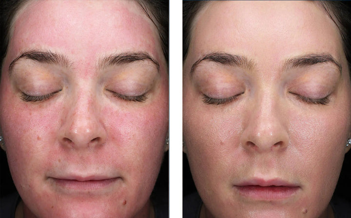 skinbetter tone smart after microneedling