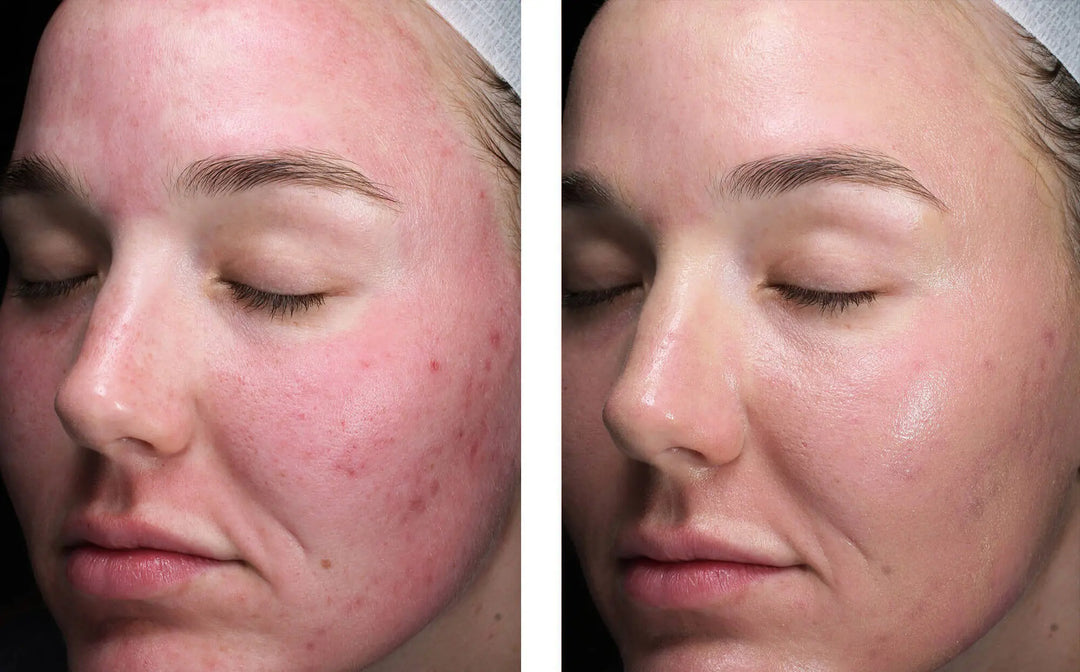 skinbetter tone smart after microneedling