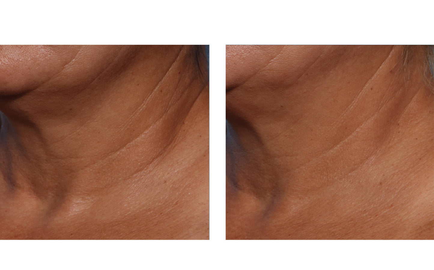 skinbetter techno neck perfecting cream before and after