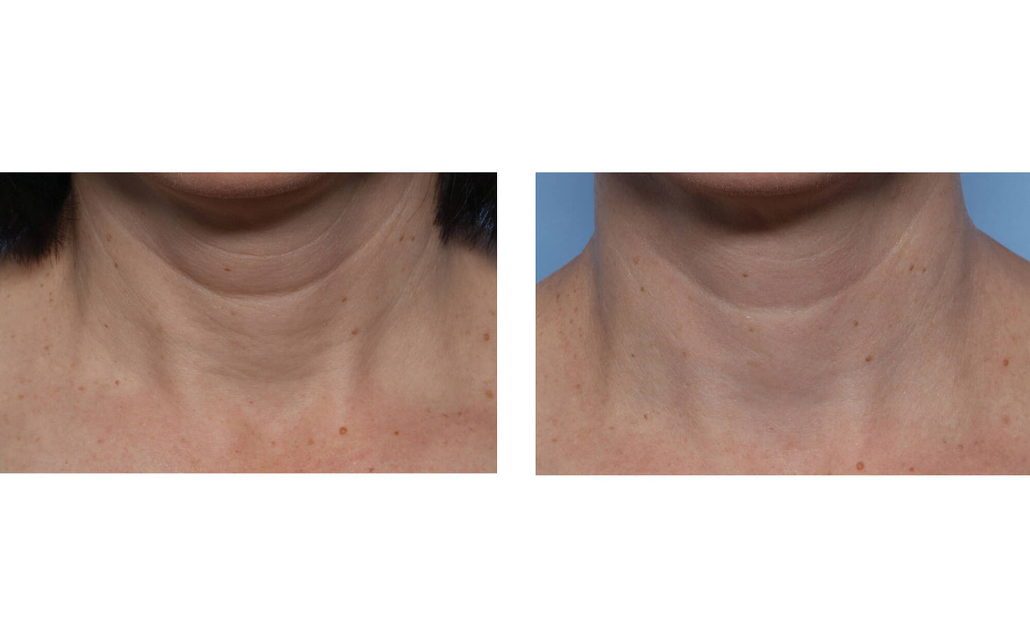 skinbetter techno neck perfecting cream before and after 12 weeks