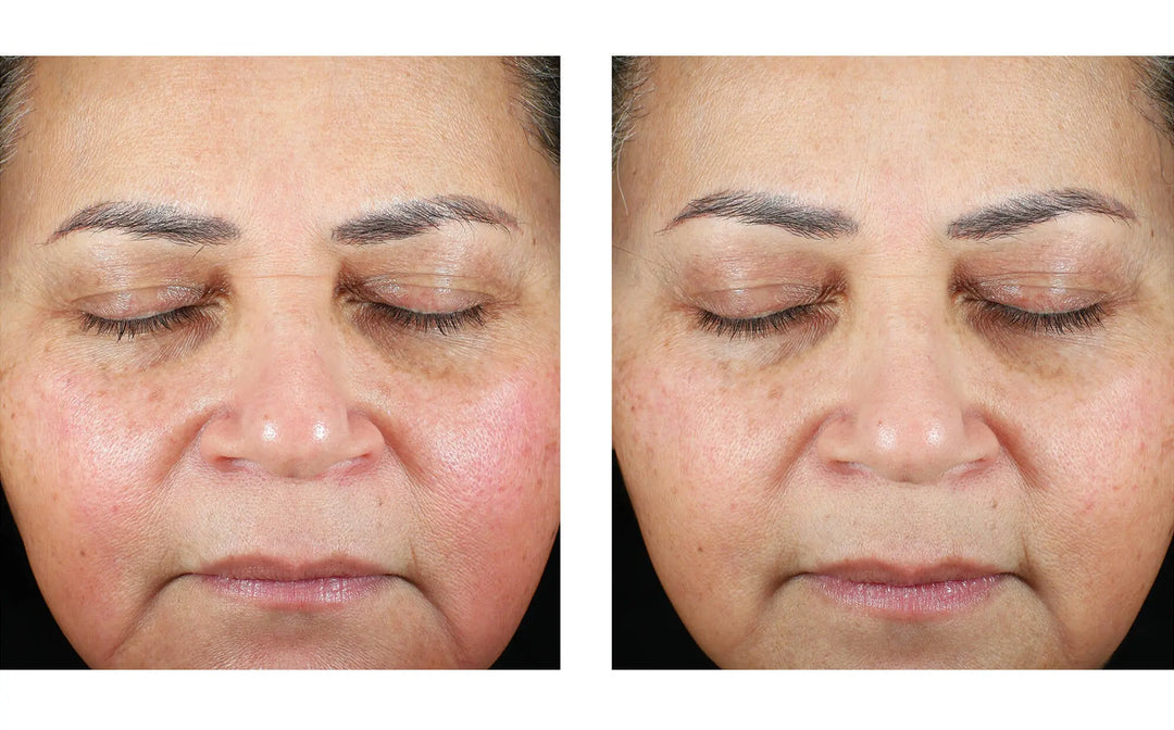 Trio Luxe Moisture Treatment | Skinbetter Skinbetter