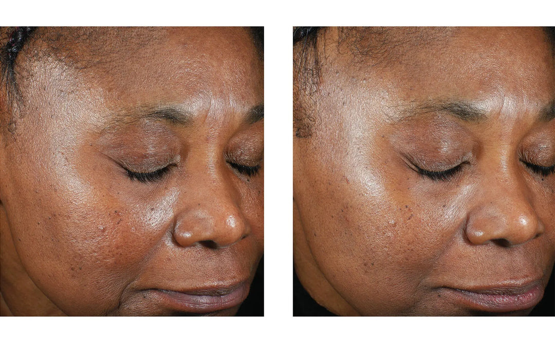 Trio Luxe Moisture Treatment | Skinbetter