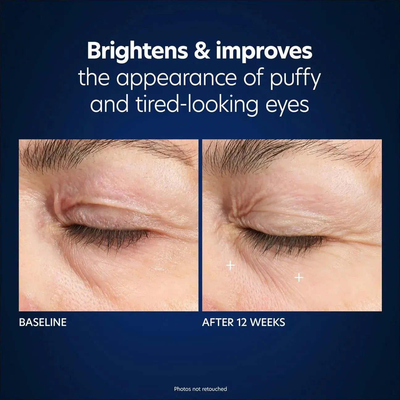 PCA Skin Hyaluronic Acid Microneedle Patches before and after