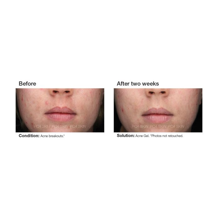PCA Skin® Acne Gel before and after