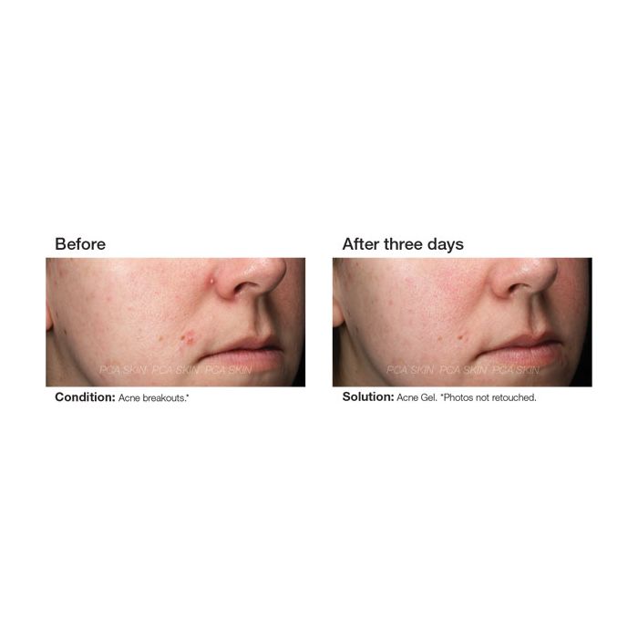 PCA Skin® Acne Gel before and after