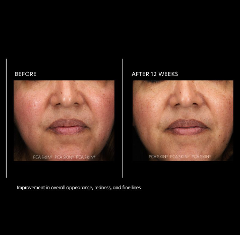 PCA Skin Resurfacing Serum before & after!