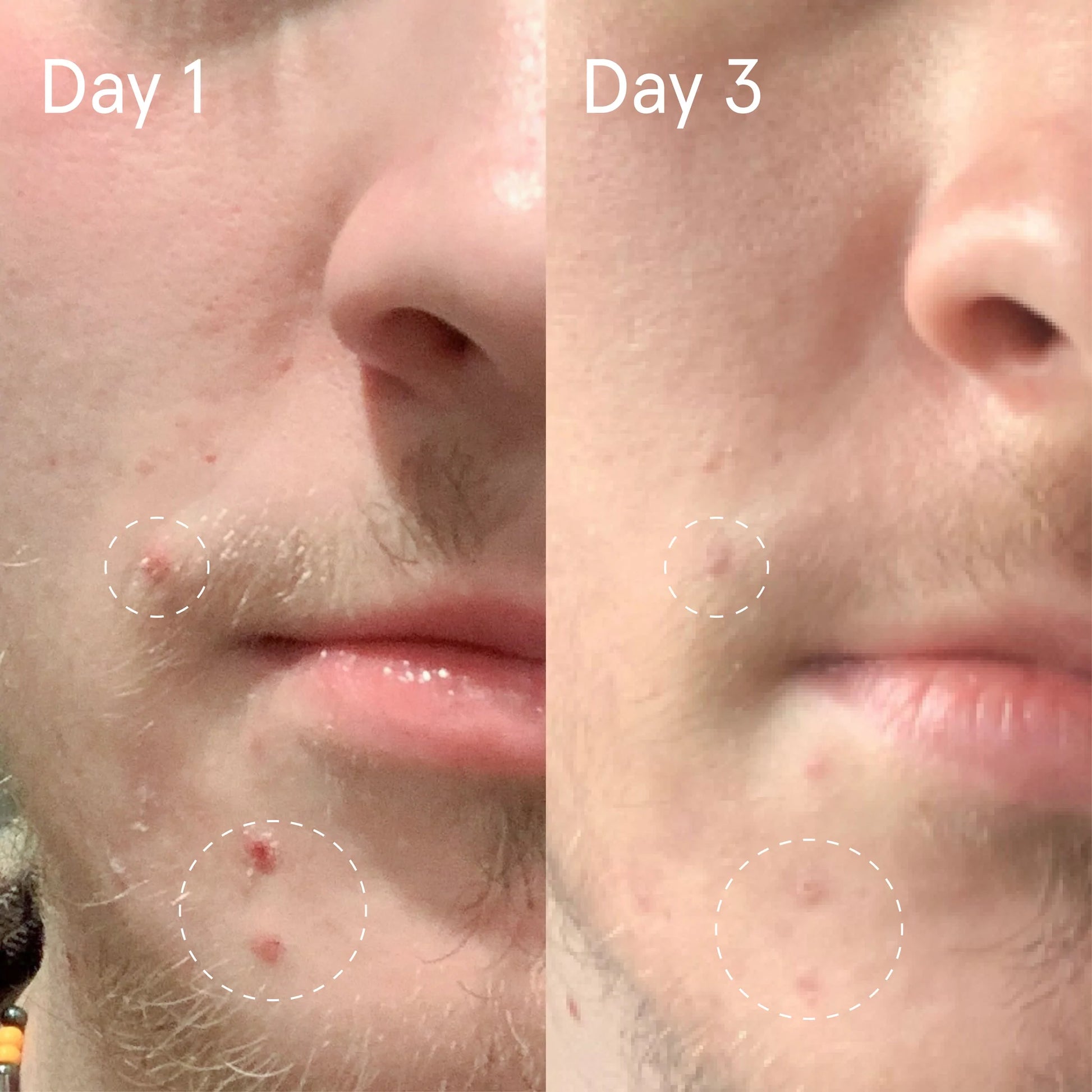 Face Reality Sulfur Spot Treatment, best acne treatment, acne cream