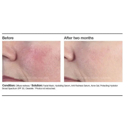 PCA SKIN® Anti-Redness Serum before & after