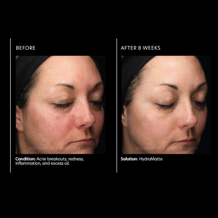 PCA Skin Hydramatte before & after, best moisturizer for oily skin	