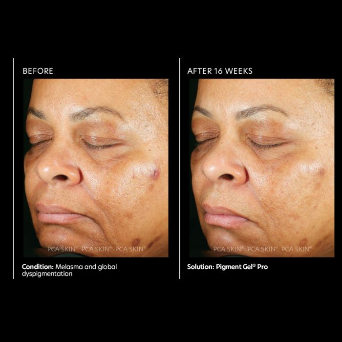 PCA Skin Pigment Gel® Pro before & after