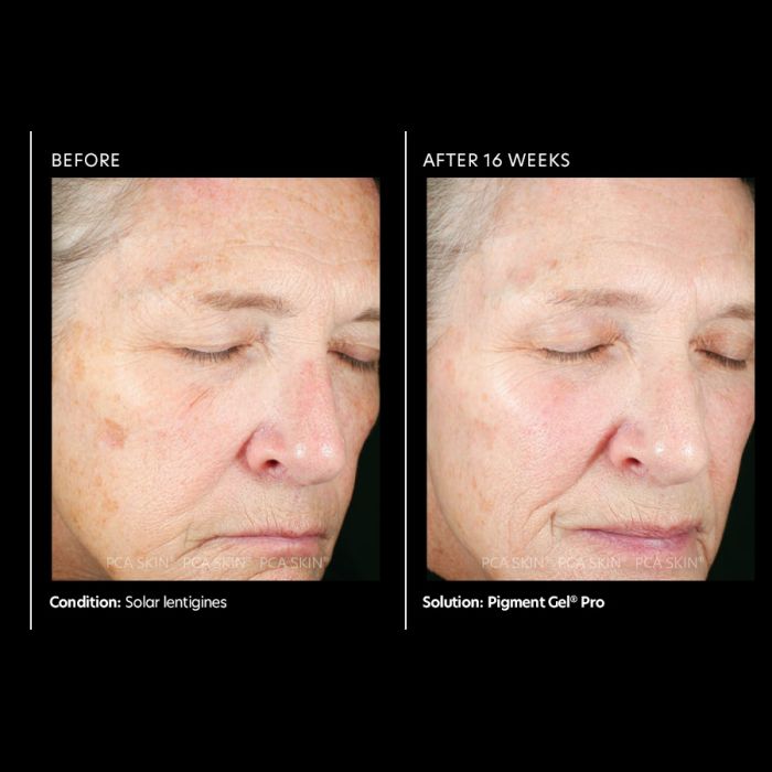 PCA Skin Pigment Gel® Pro before & after
